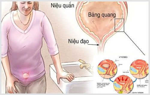 cấu tạo viêm đường tiết niệu cấu tạo viêm đường tiết niệu