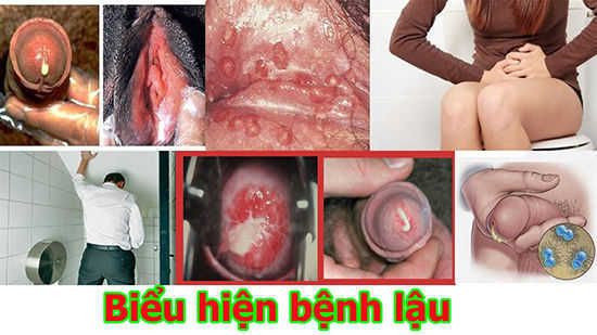 biểu hiện của bệnh lậu biểu hiện của bệnh lậu