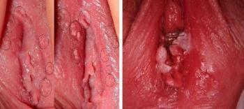 hình ảnh sùi mào gà -4 hình ảnh sùi mào gà -4