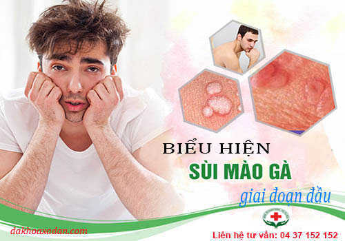 Biểu hiện sùi mào gà giai đoạn đầu Biểu hiện sùi mào gà giai đoạn đầu