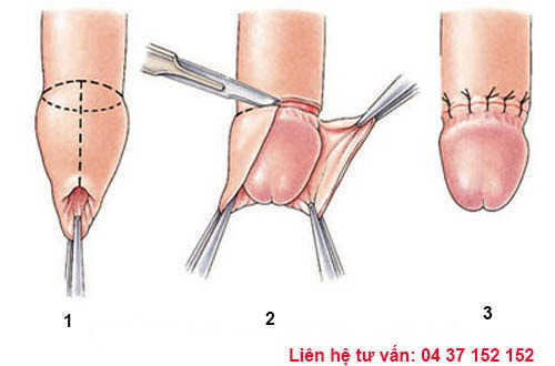 quy trình cắt bao quy đầu