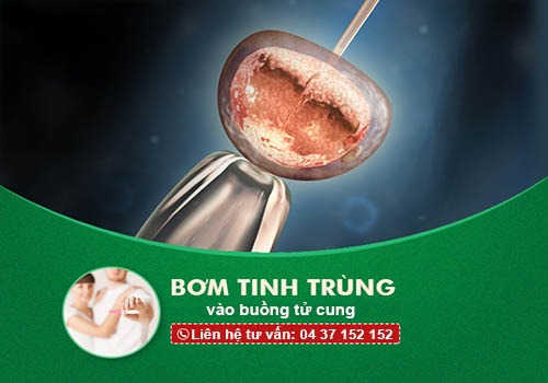 thụ tinh nhân tạo
