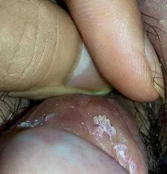 hình ảnh sùi mào gà-2 hình ảnh sùi mào gà-2