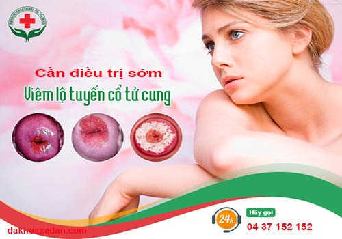 điều trị viêm lộ tuyến cổ tử cung