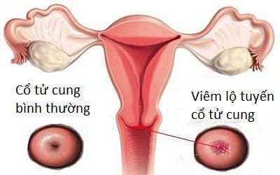 hình ảnh viêm lộ tuyến cổ tử cung hình ảnh viêm lộ tuyến cổ tử cung
