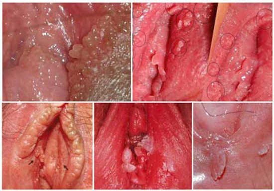 hình ảnh sùi mào gà ở nữ giới hình ảnh sùi mào gà ở nữ giới