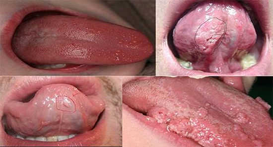 hình ảnh sùi mào gà ở miệng
