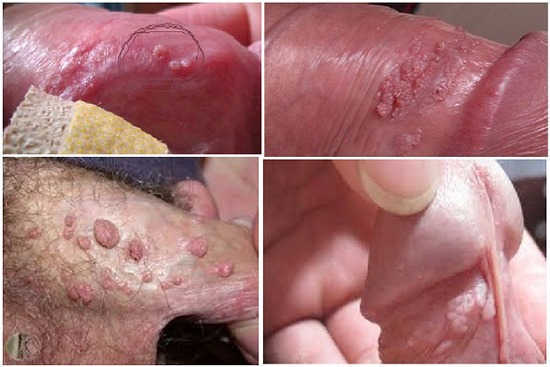 hình ảnh bệnh sùi mào gà ở nam