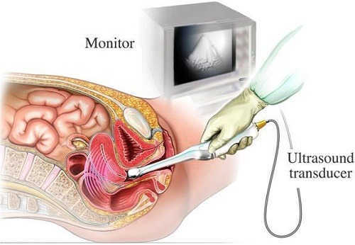cách nhận biết viêm vòi trứng