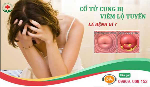 Cổ tử cung bị viêm lộ tuyến là bệnh gì?