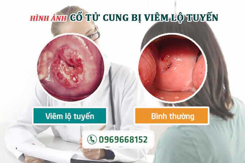 Hình ảnh cổ tử cung bị viêm lộ tuyến