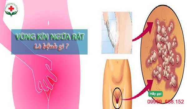 Ngứa rát vùng kín