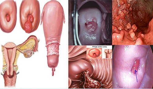 polyp cổ tử cung polyp cổ tử cung