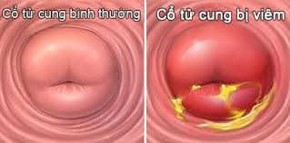 viêm cổ tử cung viêm cổ tử cung