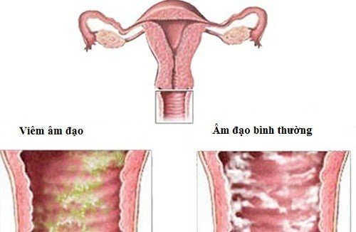 viêm âm đạo viêm âm đạo