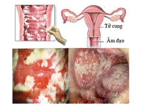 âm đạo có dịch màu trắng và không hôi