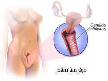 nấm âm đạo