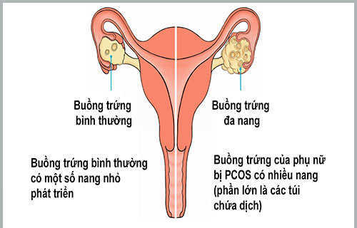 BUỒNG TRỨNG ĐA NANG-TẤT TẦN TẬT NHỮNG ĐIỀU BẠN CẦN BIẾT 1 hình ảnh buồng trứng bình thường và đa nang buồng trứng