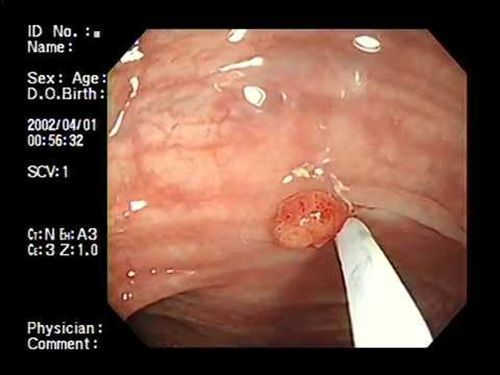 hình ảnh polyp tử cung
