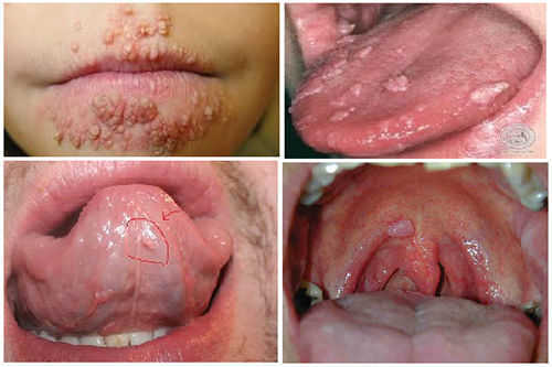 TIẾT LỘ TRIỆU CHỨNG SÙI MÀO GÀ GIÚP BẠN PHÁT HIỆN BỆNH SỚM 3 triệu chứng sùi mào gà ở miệng