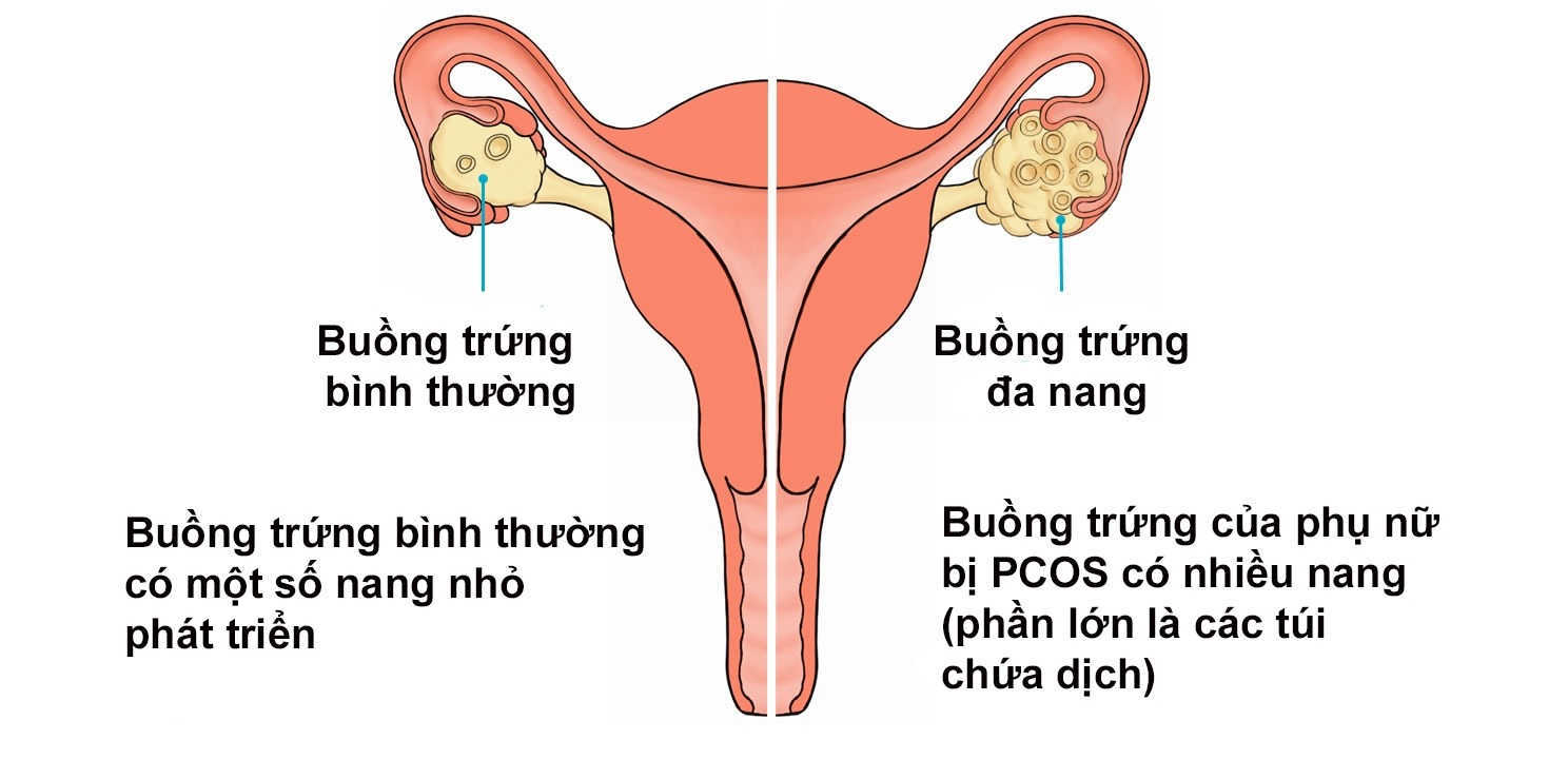 Mức độ đau bụng kinh