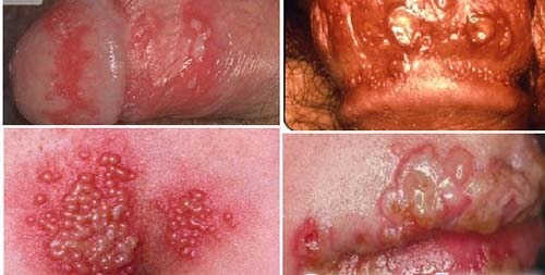 hình ảnh mụn rộp sinh dục