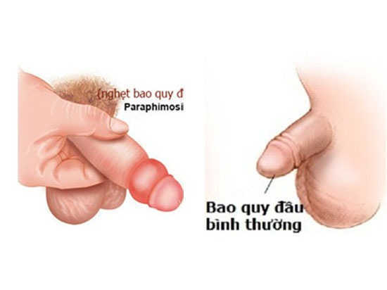 nghẹt bao quy đầu