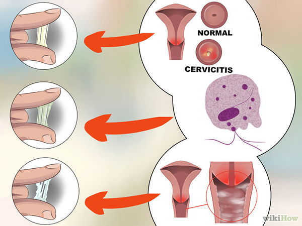 VÙNG KÍN CÓ MÙI HÔI LÀ BỆNH GÌ ? 2 khí hư ra nhiều loãng