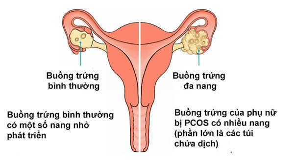 ĐA NANG BUỒNG TRỨNG 2 BÊN: NGUYÊN NHÂN & CÁCH CHỮA 1 tác hại của buồng trứng đa nang