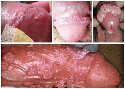 BỆNH SÙI MÀO GÀ Ở NAM - NGUYÊN NHÂN, DẤU HIỆU NHẬN BIẾT 3 Sùi mào gà dương vật