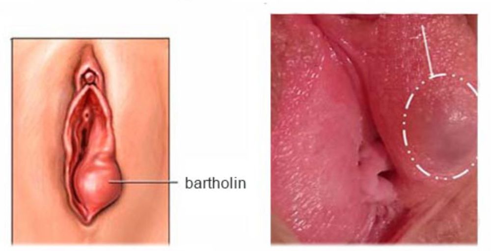 TÌM HIỂU VỀ BỆNH VIÊM TUYẾN BARTHOLIN 1 Viêm tuyến Bartholin
