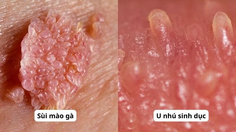 U NHÚ SINH DỤC CÓ PHẢI SÙI MÀO GÀ KHÔNG? 1 u nhu sinh duc co phai smg k