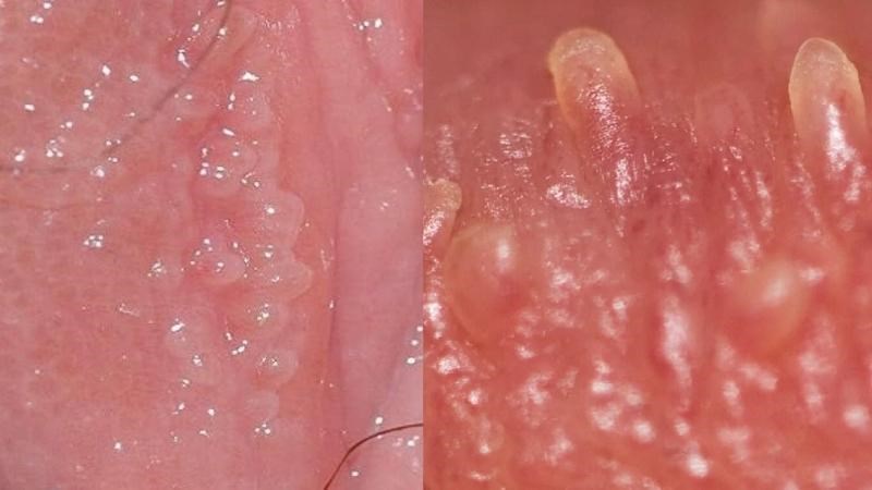 U NHÚ SINH DỤC CÓ PHẢI SÙI MÀO GÀ KHÔNG? 2 u nhu sinh duc