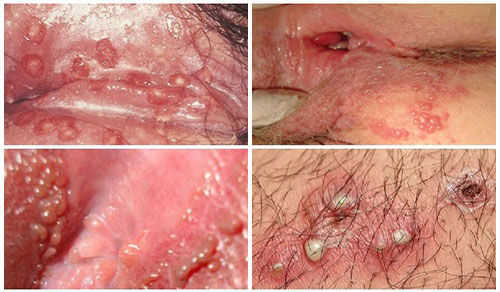 MỌC MỤN Ở VÙNG KÍN NỮ CÓ NGUY HIỂM KHÔNG? 1 cach chua mun nhot o vung kin