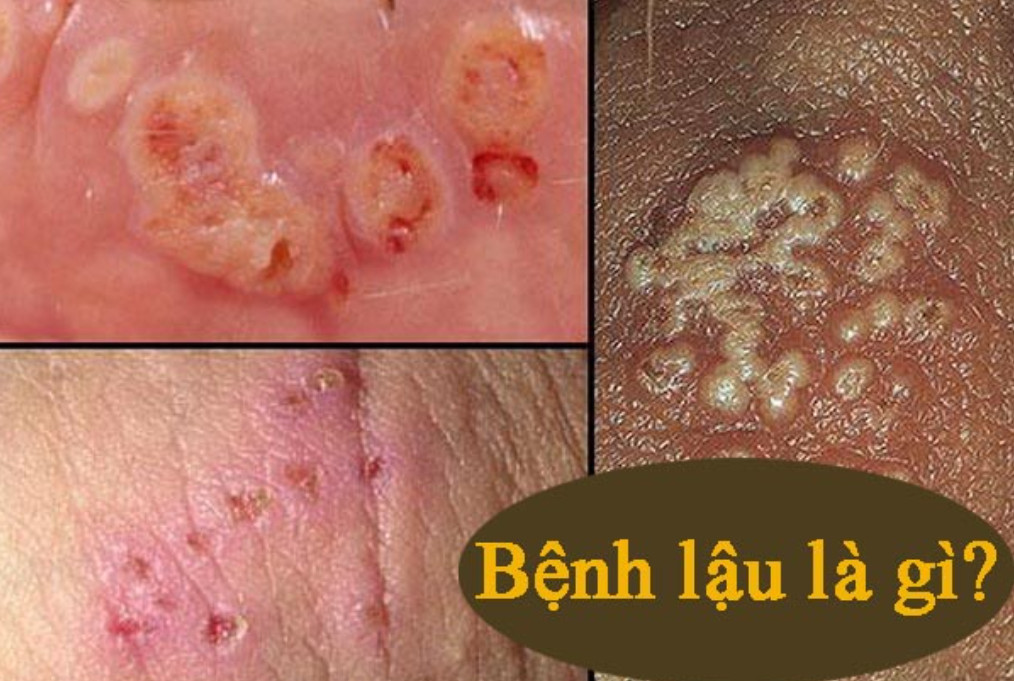 DƯƠNG VẬT CHẢY MỦ DO ĐÂU? TRIỆU CHỨNG VÀ CÁCH ĐIỀU TRỊ 3 Chảy mủ vàng ở dương vật dấu hiệu cảnh báo bệnh lậu