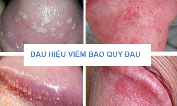 NỔI NỐT ĐỎ Ở BAO QUY ĐẦU LÀ BỆNH GÌ? 2 dau hieu viem bao quy dau 12