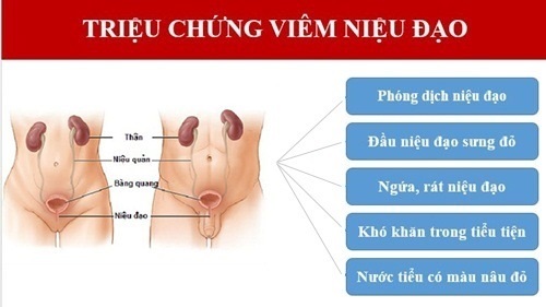 VIÊM NIỆU ĐẠO NAM: NGUYÊN NHÂN, TRIỆU CHỨNG 3 dau hieu viem nieu dao nam