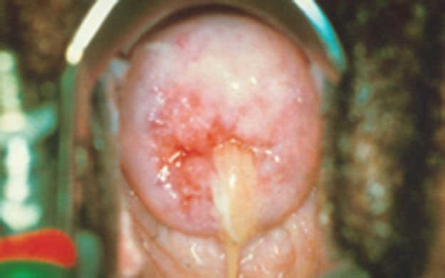 một số hình ảnh cổ tử cung bị viêm nhiễm