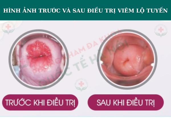 CHI PHÍ ĐỐT VIÊM LỘ TUYẾN CỔ TỬ CUNG HẾT BAO NHIÊU TIỀN 7 hinh anh truoc va sau dieu tri viem lo tuyen