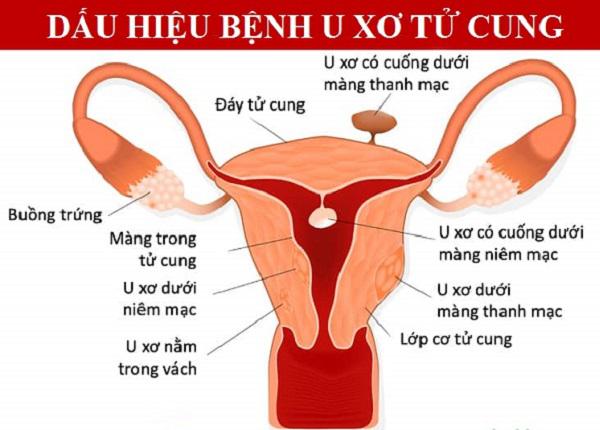 NHẬN BIẾT CÁC DẤU HIỆU U XƠ TỬ CUNG 2 Các loại u xơ tử cung
