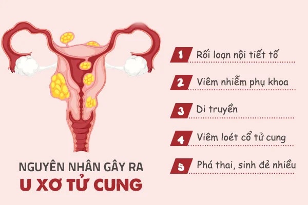 NHẬN BIẾT CÁC DẤU HIỆU U XƠ TỬ CUNG 4 Nguyên nhân gây u xơ tử cung