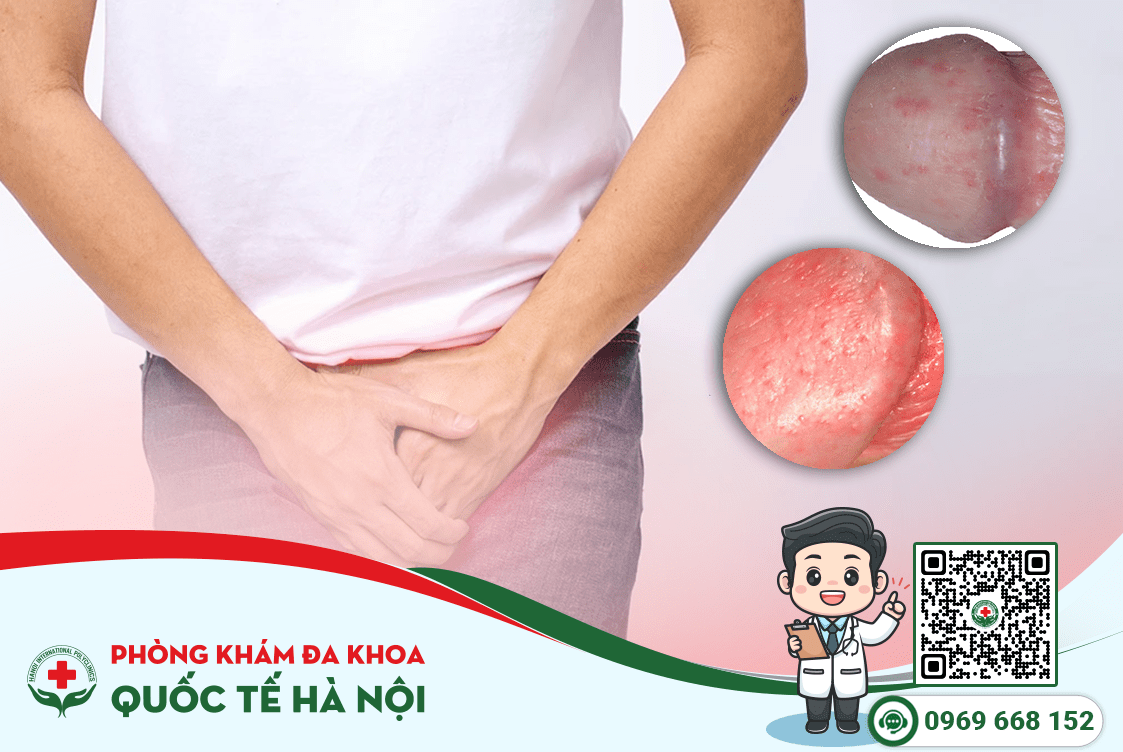 Nhận biết các nốt đỏ nổi lên ở bao quy đầu