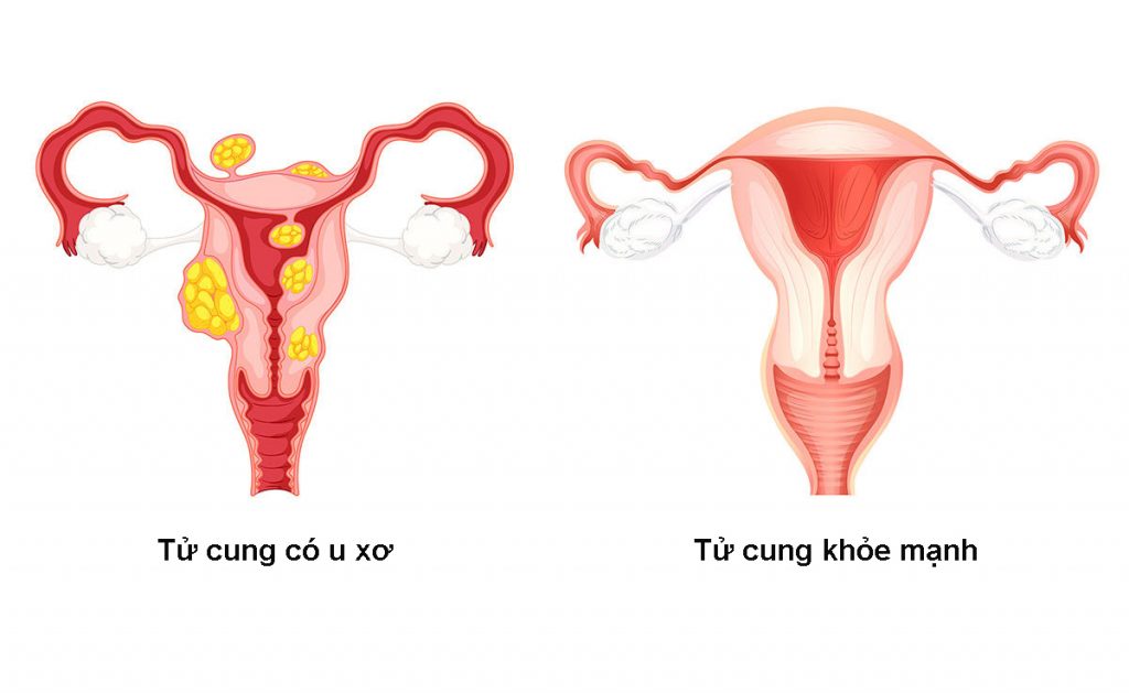 MỔ U XƠ TƯ CUNG BAO NHIÊU TIỀN? BÁC SĨ TƯ VẤN CHI TIẾT 1 u xo tc