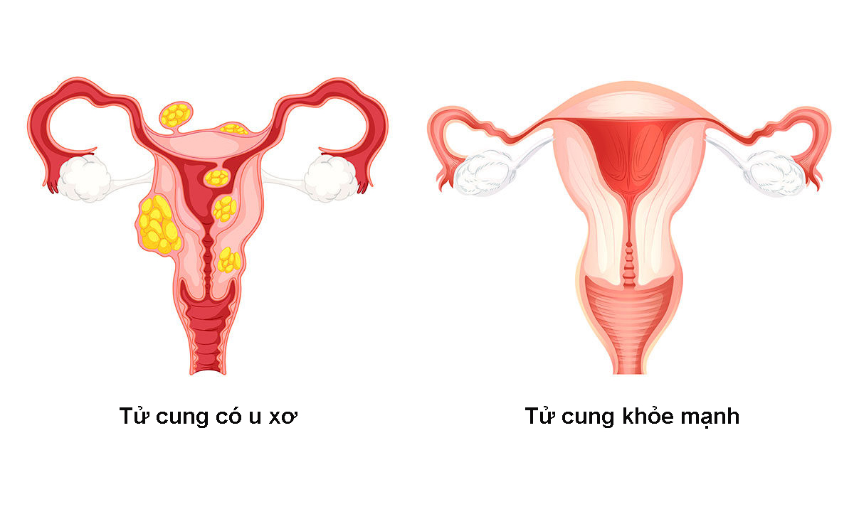 NHẬN BIẾT CÁC DẤU HIỆU U XƠ TỬ CUNG 3 U xơ tử cung