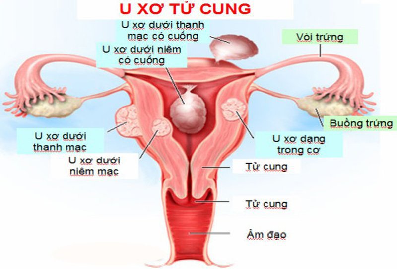 dau-hieu-u-xo-tu-cung