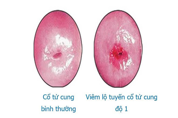 7 DẤU HIỆU VIÊM LỘ TUYẾN CỔ TỬ CUNG HAY GẶP NHẤT 4 viem lo tuyen co tu cung cap do 1