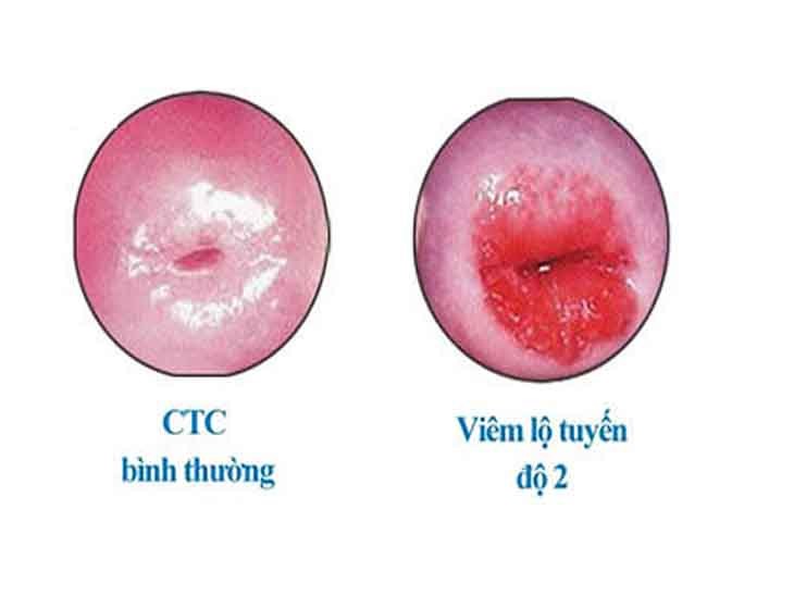 7 DẤU HIỆU VIÊM LỘ TUYẾN CỔ TỬ CUNG HAY GẶP NHẤT 5 viem lo tuyen co tu cung cap do 2