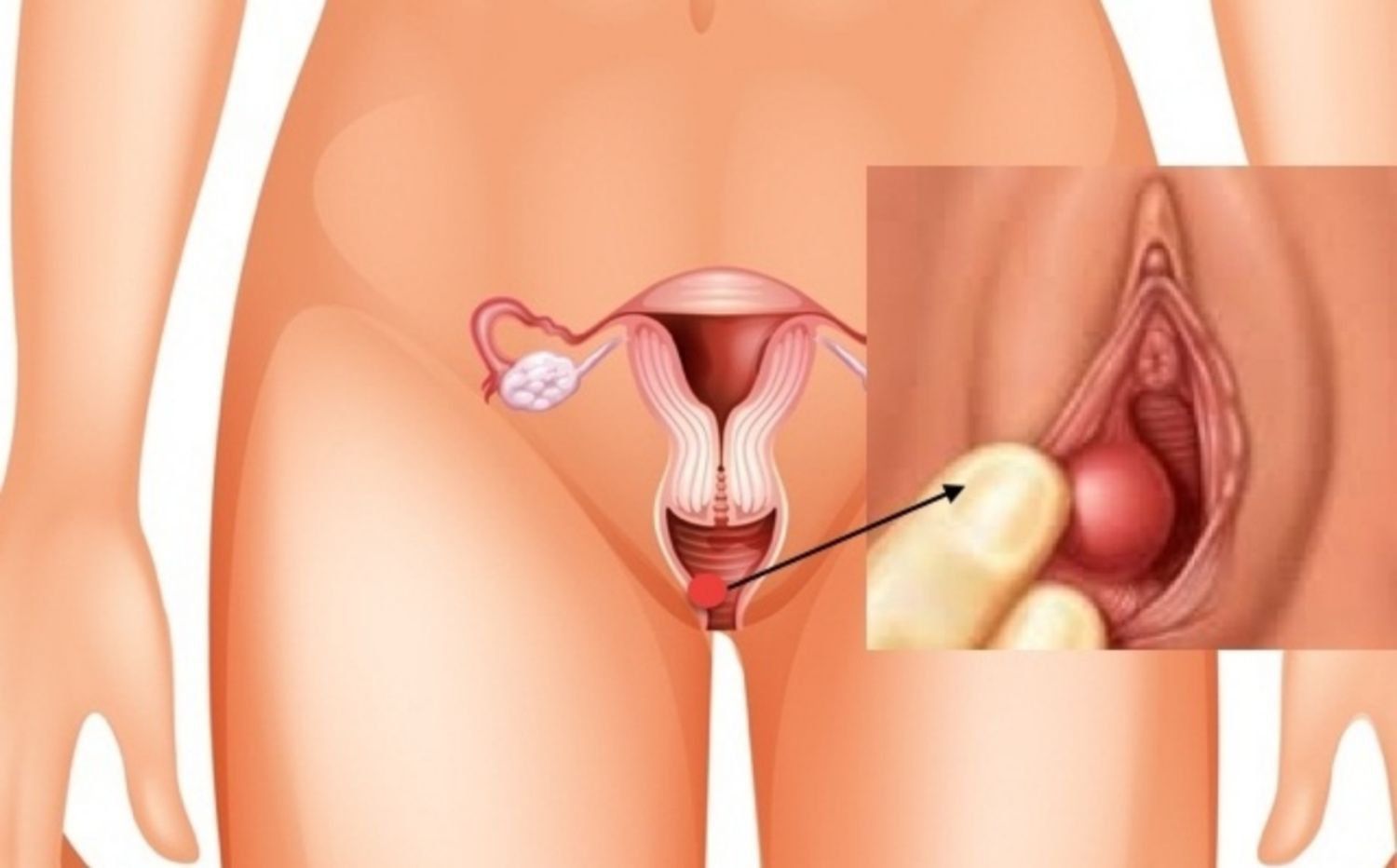 TÌM HIỂU VỀ BỆNH VIÊM TUYẾN BARTHOLIN 2 Dấu hiệu nhận biết viêm tuyến Bartholin