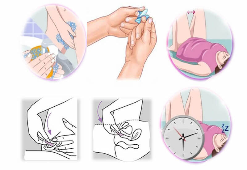 Hướng dẫn cách đặt thuốc vào âm đạo