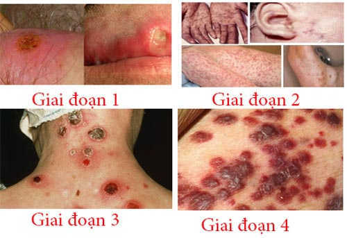 BỆNH LẬU VÀ GIANG MAI GIỐNG NHAU KHÔNG ? 2 5c0dedb7a90b660d63891c27 trieu chung benh giang mai